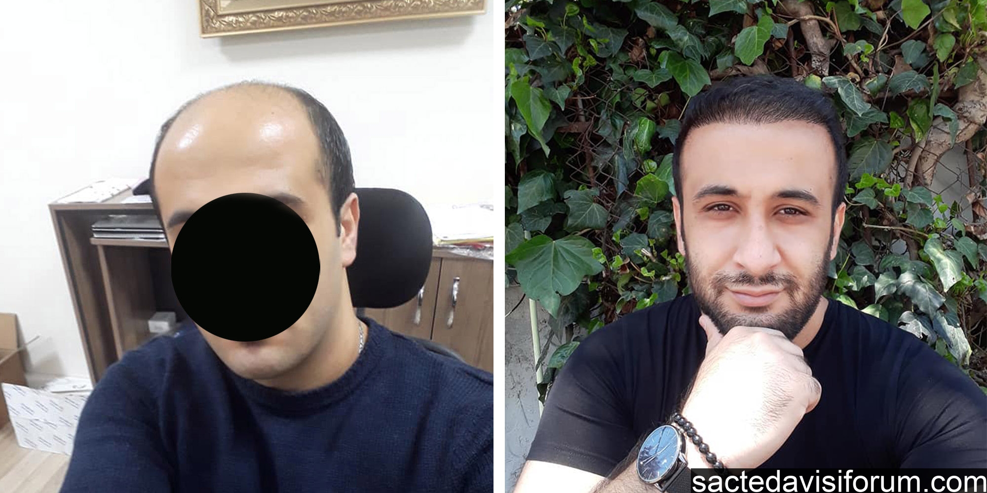 6. ay saç ekimi sonucu.jpg