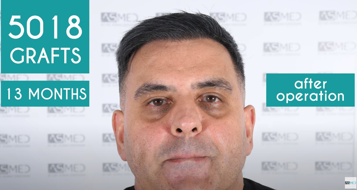 asmed saç ekimi sonrası.png