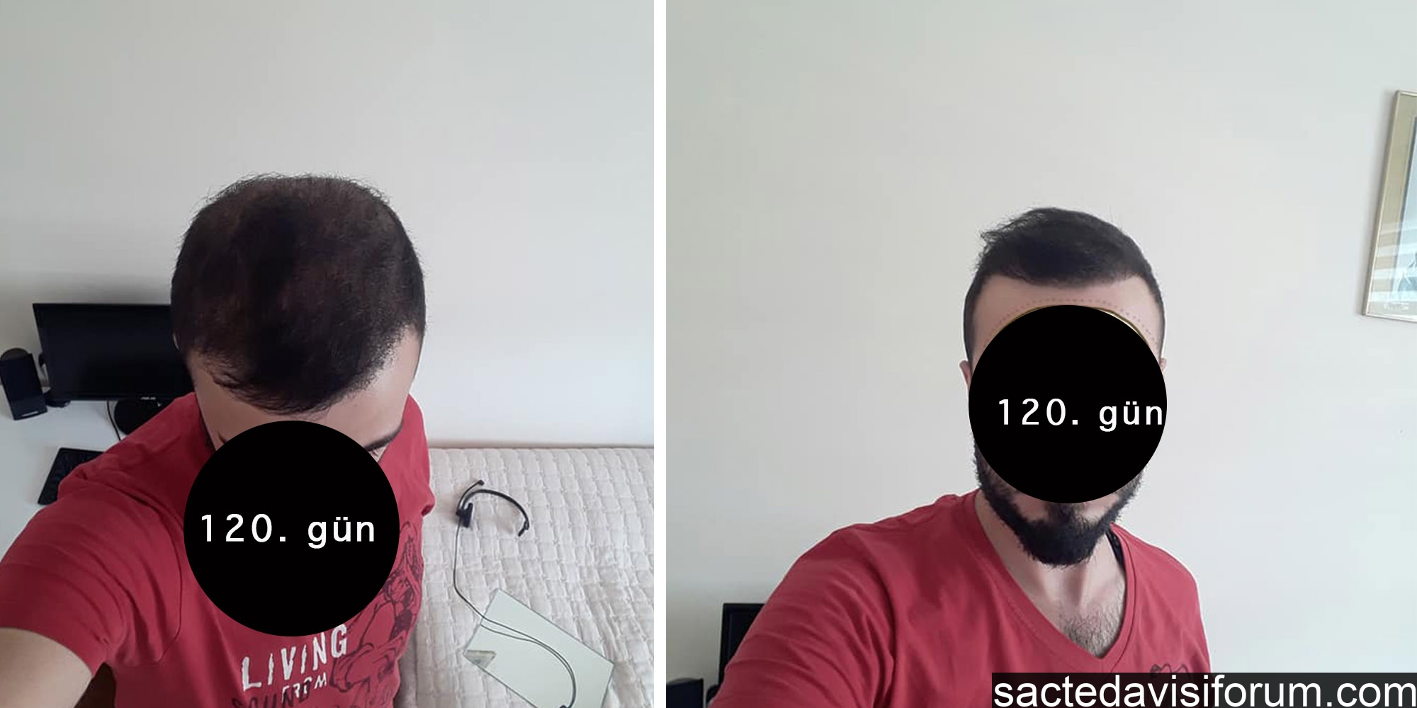saç ekimi aslı tarcan hair clinic.jpg