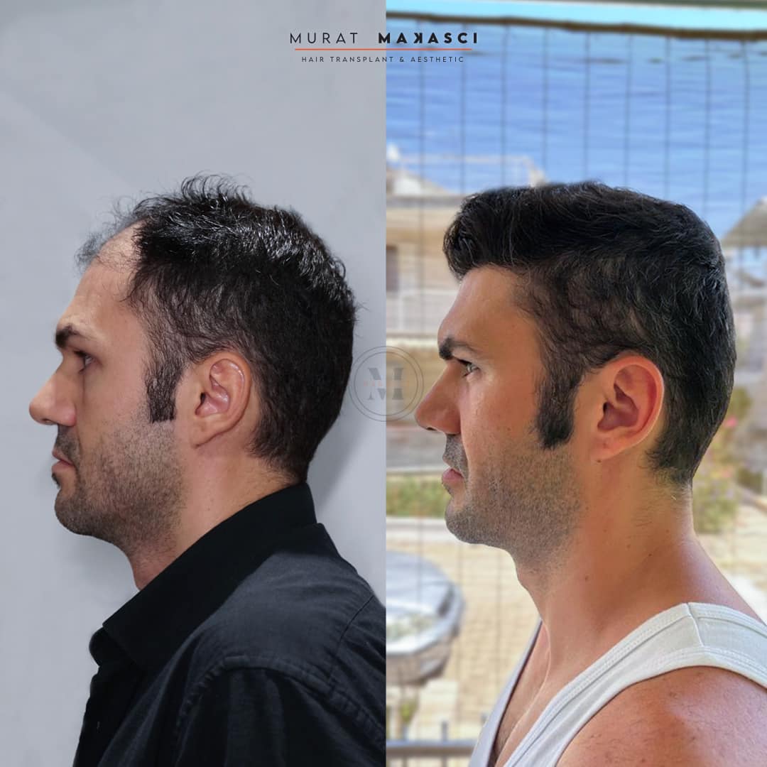 sol yan murat makascı.jpeg