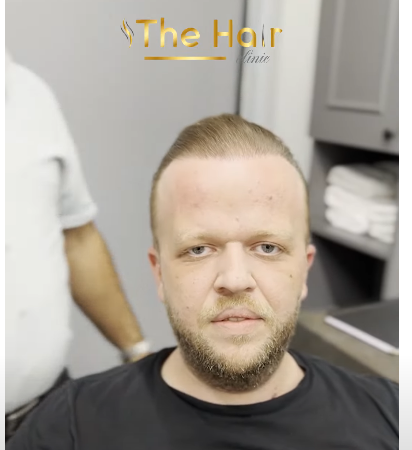 tosun saç ekimi.png