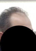 aslı tarcan saç ekimi öncesi.jpg
