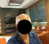 asli tarcan hair transplant.jpg