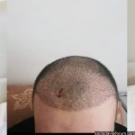 saç ekimi 6000 greft.jpg