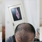 6000 greft aslı tarcan.jpg