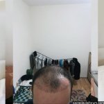 aslı tarcan saç ekimi.jpg
