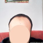 saç ekimi öncesi.jpg