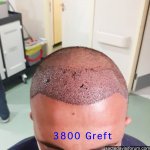3800 greft saç ekimi.jpg