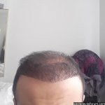 saç ekimi sonrası.jpg
