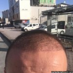 saç ekimi greft.jpg