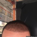 şök dökülme hair fue.jpg