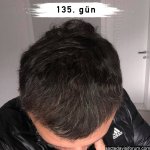 saç ekimi sonuçları.jpg