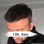maya estetik saç ekimi.jpg