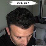 saç ekimi sonrası.jpg
