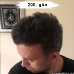 saç ekimi sonuçları maya estetik.jpg
