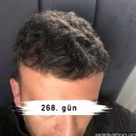 saç ekimi sonuçları.jpg