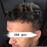saç ekimi.jpg
