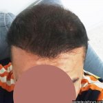 arenamed saç ekimi sonuçları.jpg