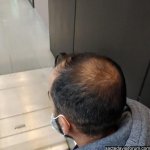 saç ekimi öncesi.jpg