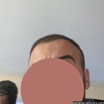 saç ekimi 3,5 aylık.jpg