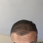 3, 5 aylık saç ekimi.jpg