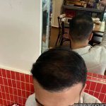 zen clinic saç ekimi resimleri.jpg
