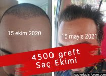 saç ekimi 4500 greft.jpg