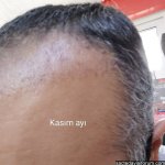 kıbrıs saç ekimi.jpg