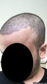 kayseri can hair saç.jpg