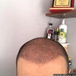 fehmi arman saç ekimi.jpg