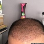 şok dökülme saç ekimi.jpg
