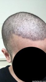 kayseri can hair saç ekimii.jpg