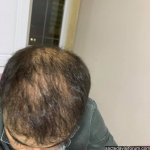 saç ekimi tepe bölgesi.jpg