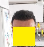 serkan aygın 5000 greft.jpg