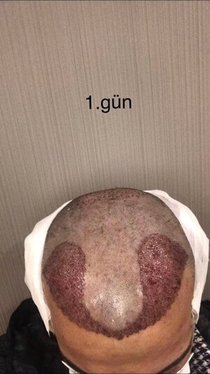 serkan aygın saç ekimi 1. gün.jpeg